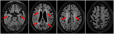 Case Report: Anti-N-Methyl-D-Aspartate Receptor Encephalitis in an Elderly Patient With Primary Sjögren's Syndrome